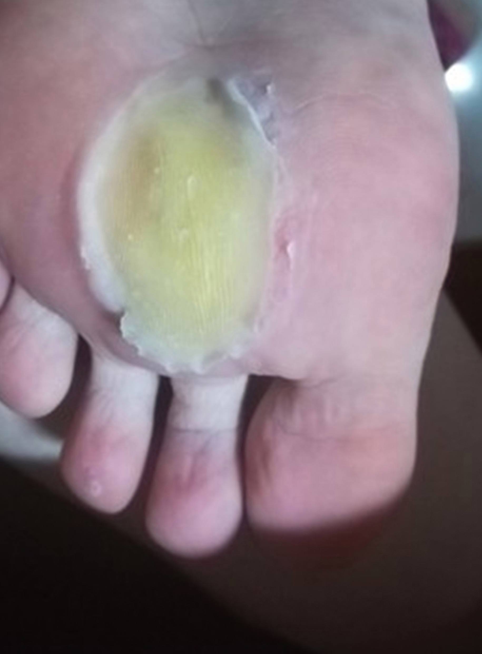 鸡眼膏的正确使用方法是什么